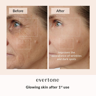 SKIN REJUVENATION BUNDLE - Evertone Skin